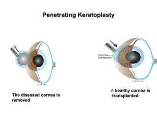 Penetrating KeratoplastyPenetrating Keratoplasty
The diseased cornea isThe diseased cornea is
removedremoved
AA healthy cornea ishealthy cornea is
transplantedtransplanted
 