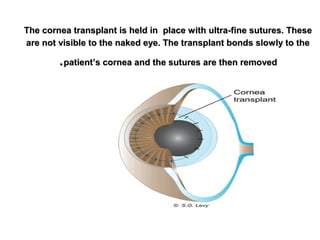 The cornea transplant is held inThe cornea transplant is held in place with ultra-fine sutures. Theseplace with ultra-fine sutures. These
are not visible to the naked eye. The transplant bonds slowly to theare not visible to the naked eye. The transplant bonds slowly to the
patient’s cornea and the sutures are then removedpatient’s cornea and the sutures are then removed..
 