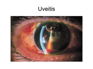 Uveitis
 
