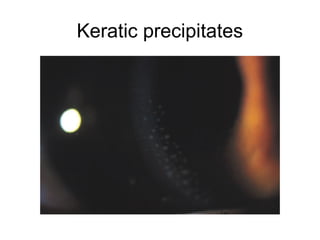 Keratic precipitates
 