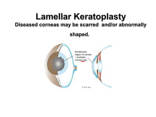 Lamellar KeratoplastyLamellar Keratoplasty
Diseased corneas may be scarred and/or abnormallyDiseased corneas may be scarred and/or abnormally
shaped.shaped.
 