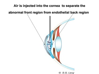 Air is injected into the cornea to separate theAir is injected into the cornea to separate the
abnormal front region from endothelialabnormal front region from endothelial back regionback region
 