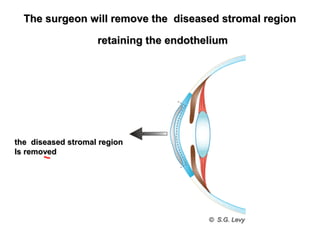 The surgeon will remove the diseased stromal regionThe surgeon will remove the diseased stromal region
retaining the endotheliumretaining the endothelium
the diseased stromal regionthe diseased stromal region
Is removedIs removed
 