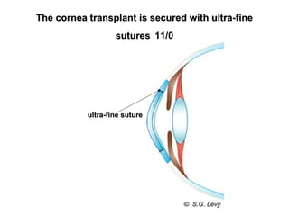 The cornea transplant is secured with ultra-fineThe cornea transplant is secured with ultra-fine
suturessutures 11/0
ultra-fine sutureultra-fine suture
 