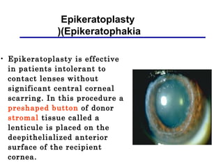 • Epikeratoplasty is effective
in patients intolerant to
contact lenses without
significant central corneal
scarring. In this procedure a
preshaped button of donor
stromal tissue called a
lenticule is placed on the
deepithelialized anterior
surface of the recipient
cornea.
Epikeratoplasty
(Epikeratophakia(
 