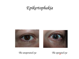 Epikertophakia
The unoperated eye The operated eye
 
