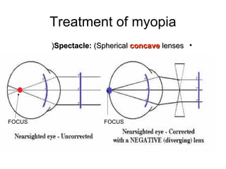Treatment of myopia
•Spectacle:Spectacle: (Spherical(Spherical concaveconcave lenseslenses))
•
FOCUS FOCUS
 