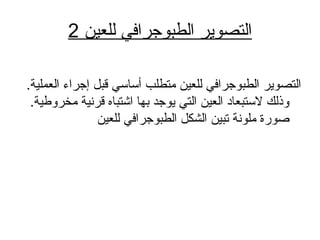 ‫للعاي ن‬ ‫الطبوجرافي‬ ‫التصوير‬2
.‫العملاية‬ ‫إجراء‬ ‫قبل‬ ‫أةلسلساةلسلسي‬ ‫متطلب‬ ‫للعاي ن‬ ‫الطبوجرافي‬ ‫التصوير‬
.‫مخروطاية‬ ‫قرناية‬ ‫اشتباه‬ ‫بها‬ ‫يوجد‬ ‫التي‬ ‫العاي ن‬ ‫لةلسلستبعاد‬ ‫وذلك‬
‫للعاي ن‬ ‫الطبوجرافي‬ ‫الشكل‬ ‫تباي ن‬ ‫ملونة‬ ‫صو رة‬
 