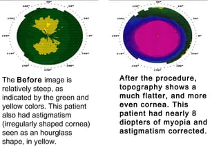 The Before image is
relatively steep, as
indicated by the green and
yellow colors. This patient
also had astigmatism
(irregularly shaped cornea)
seen as an hourglass
shape, in yellow.
After the procedure,
topography shows a
much flatter, and more
even cornea. This
patient had nearly 8
diopters of myopia and
astigmatism corrected.
 
