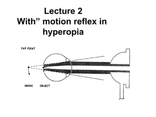 Lecture 2
With” motion reflex in
hyperopia
 