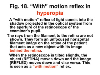 Fig. 18. “With” motion reflex in
hyperopia
A “with motion” reflex of light comes into the
shadow projected in the optical system from
the aperture of the retinoscope or the
examiner's pupil.
The rays from the filament to the retina are not
shown. They form an unfocused horizontal
filament image on the retina of the patient
that acts as a new object with its image
behind the retina.
When the retinoscope is tilted slightly, the
object (RETINA) moves down and the image
(REFLEX) moves down and vise versa. This
is seen as a “with motion” reflex.
 