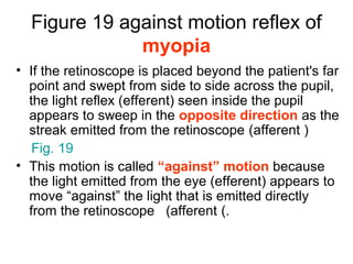 Figure 19 against motion reflex of
myopia
• If the retinoscope is placed beyond the patient's far
point and swept from side to side across the pupil,
the light reflex (efferent) seen inside the pupil
appears to sweep in the opposite direction as the
streak emitted from the retinoscope (afferent )
Fig. 19
• This motion is called “against” motion because
the light emitted from the eye (efferent) appears to
move “against” the light that is emitted directly
from the retinoscope (afferent (.
 