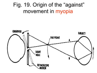 Fig. 19. Origin of the “against”
movement in myopia
 