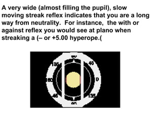 A very wide (almost filling the pupil), slow
moving streak reflex indicates that you are a long
way from neutrality. For instance, the with or
against reflex you would see at plano when
streaking a (– or +5.00 hyperope.(
 