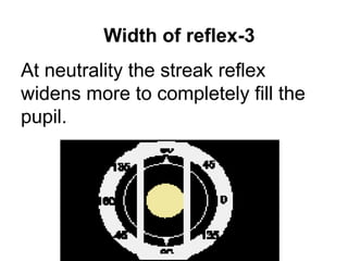 At neutrality the streak reflex
widens more to completely fill the
pupil.
3-Width of reflex
 