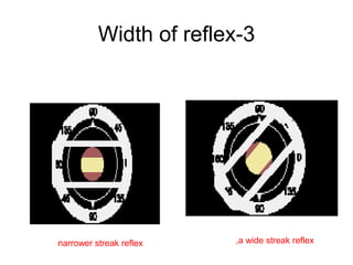 3-Width of reflex
a wide streak reflex,narrower streak reflex
 