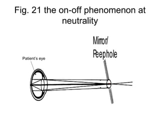 Fig. 21 the on-off phenomenon at
neutrality
Patient’s eye
 