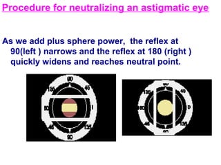 As we add plus sphere power, the reflex at
90(left ) narrows and the reflex at 180 (right )
quickly widens and reaches neutral point.
Procedure for neutralizing an astigmatic eye
 