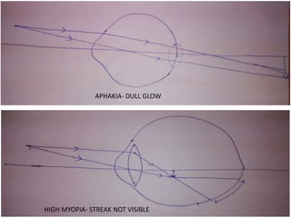 APHAKIA- DULL GLOW
HIGH MYOPIA- STREAK NOT VISIBLE
 