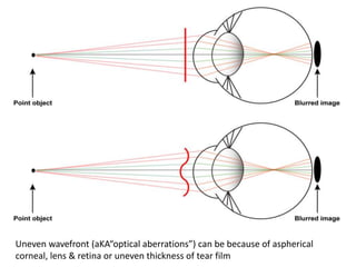 Uneven wavefront (aKA“optical aberrations”) can be because of aspherical
corneal, lens & retina or uneven thickness of tear film
 