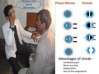 Advantages of streak -
Undilated pupil
More accurate
Astigmatism
Axis of the astigmatism
D GOOD OLD
DAYZZ
DR.SHASHI
 