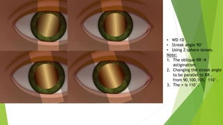 • WD 1D
• Streak angle 90°
• Using 2 sphere lenses.
Note:
1. The oblique RR 
astigmatism
2. Changing the streak angle
to be parallel to RR ,
from 90,100,105, 110°.
3. The × is 110°.
 