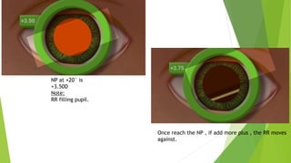 NP at ×20° is
+3.50D
Note:
RR filling pupil.
Once reach the NP , if add more plus , the RR moves
against.
 