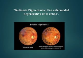 "Retinosis Pigmentaria: Una enfermedad
degenerativa de la retina".
 