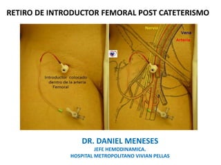 RETIRO DE INTRODUCTOR FEMORAL POST CATETERISMO
DR. DANIEL MENESES
JEFE HEMODINAMICA.
HOSPITAL METROPOLITANO VIVIAN PELLAS
 