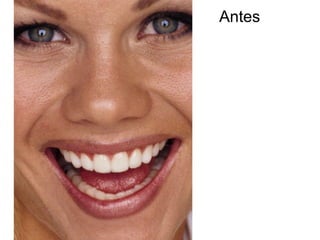 Antes 