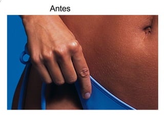 Antes 