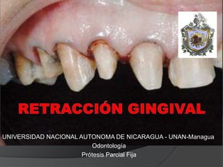 UNIVERSIDAD NACIONAL AUTONOMA DE NICARAGUA - UNAN-Managua
Odontología
Prótesis Parcial Fija

 
