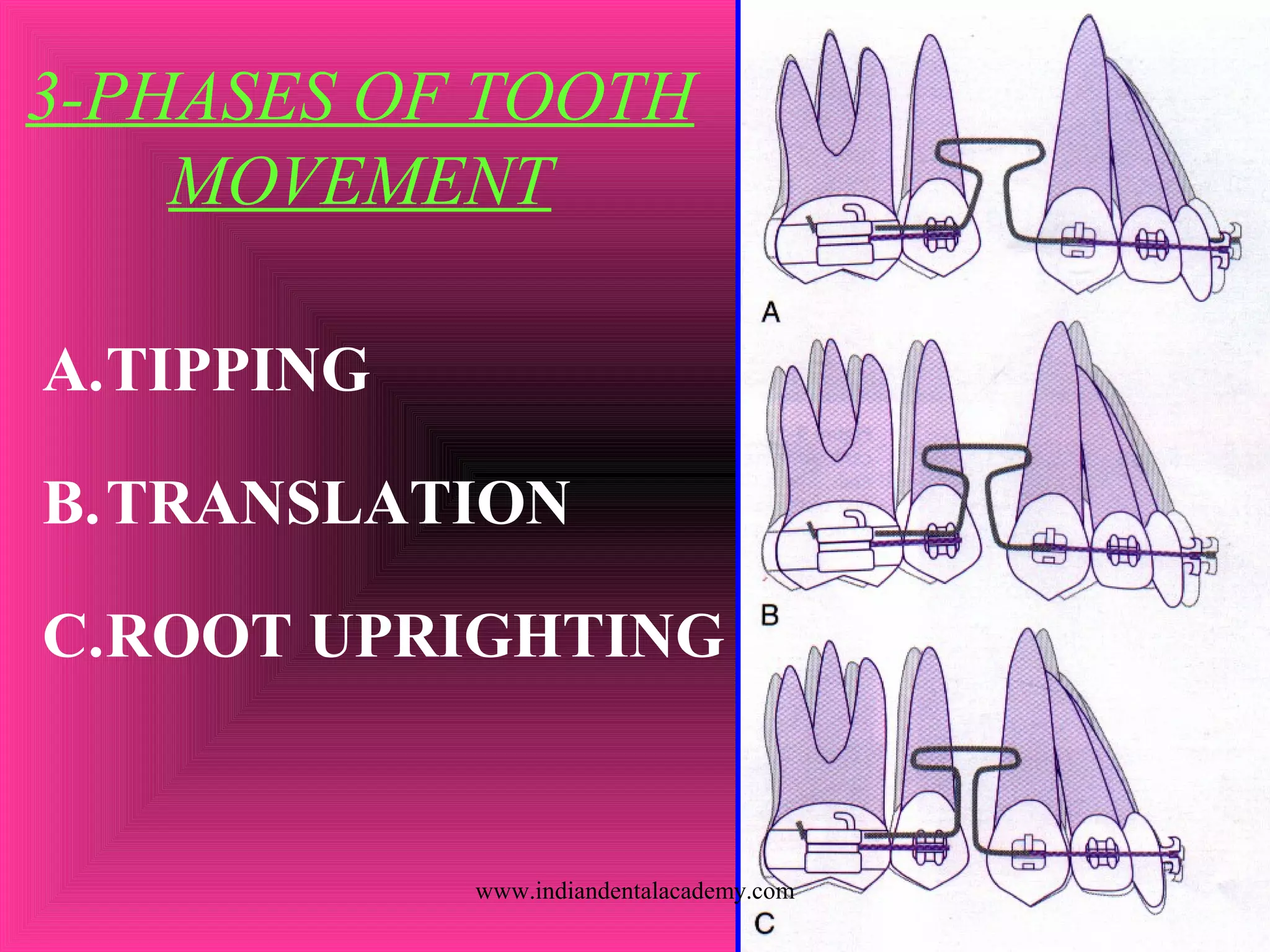 3-PHASES OF TOOTH
MOVEMENT
A.TIPPING
B.TRANSLATION
C.ROOT UPRIGHTING
www.indiandentalacademy.com
 