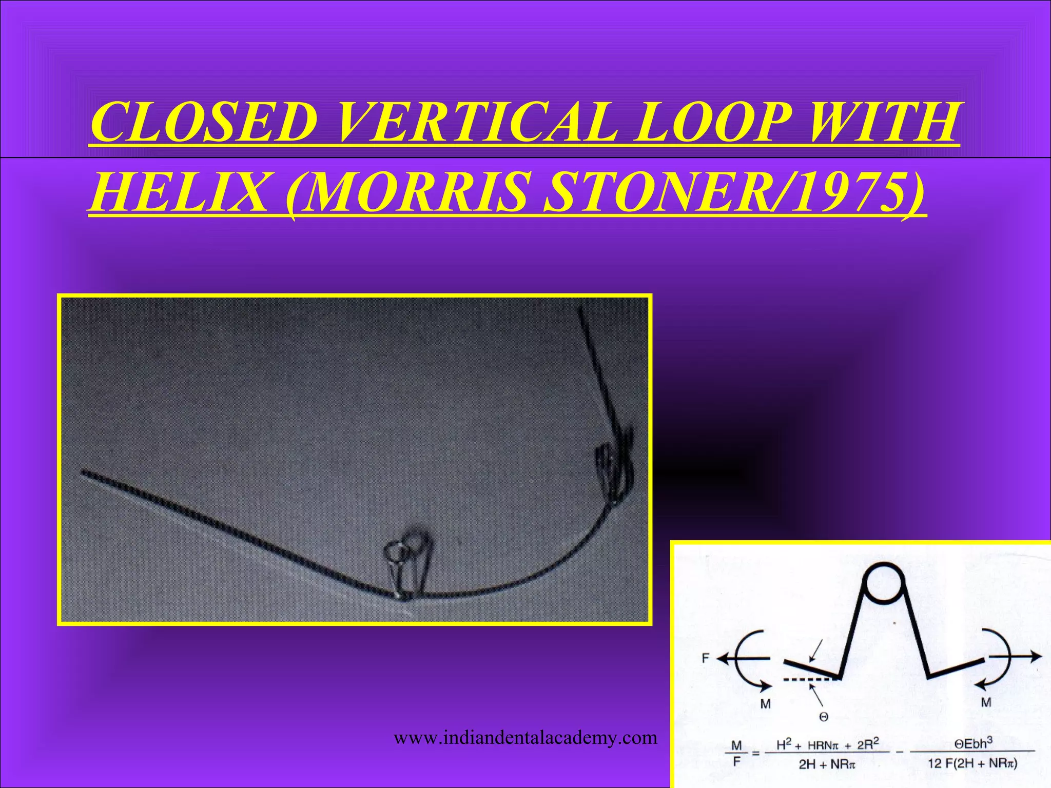 CLOSED VERTICAL LOOP WITH
HELIX (MORRIS STONER/1975)
www.indiandentalacademy.com
 
