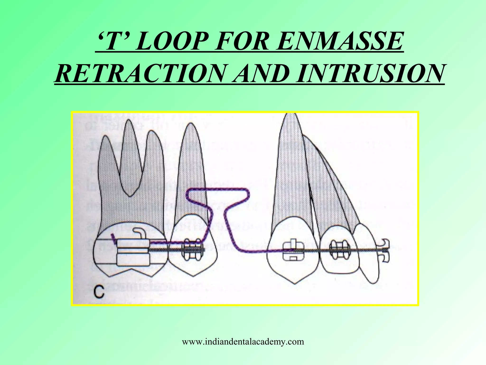 ‘T’ LOOP FOR ENMASSE
RETRACTION AND INTRUSION
www.indiandentalacademy.com
 