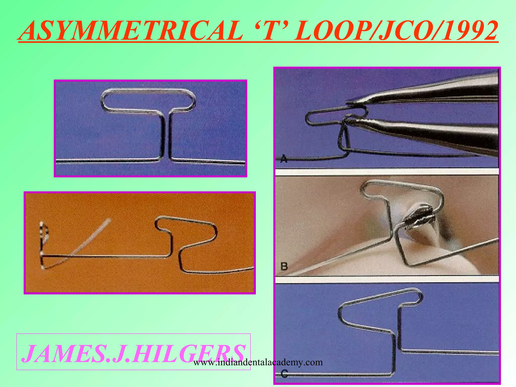 ASYMMETRICAL ‘T’ LOOP/JCO/1992
JAMES.J.HILGERSwww.indiandentalacademy.com
 
