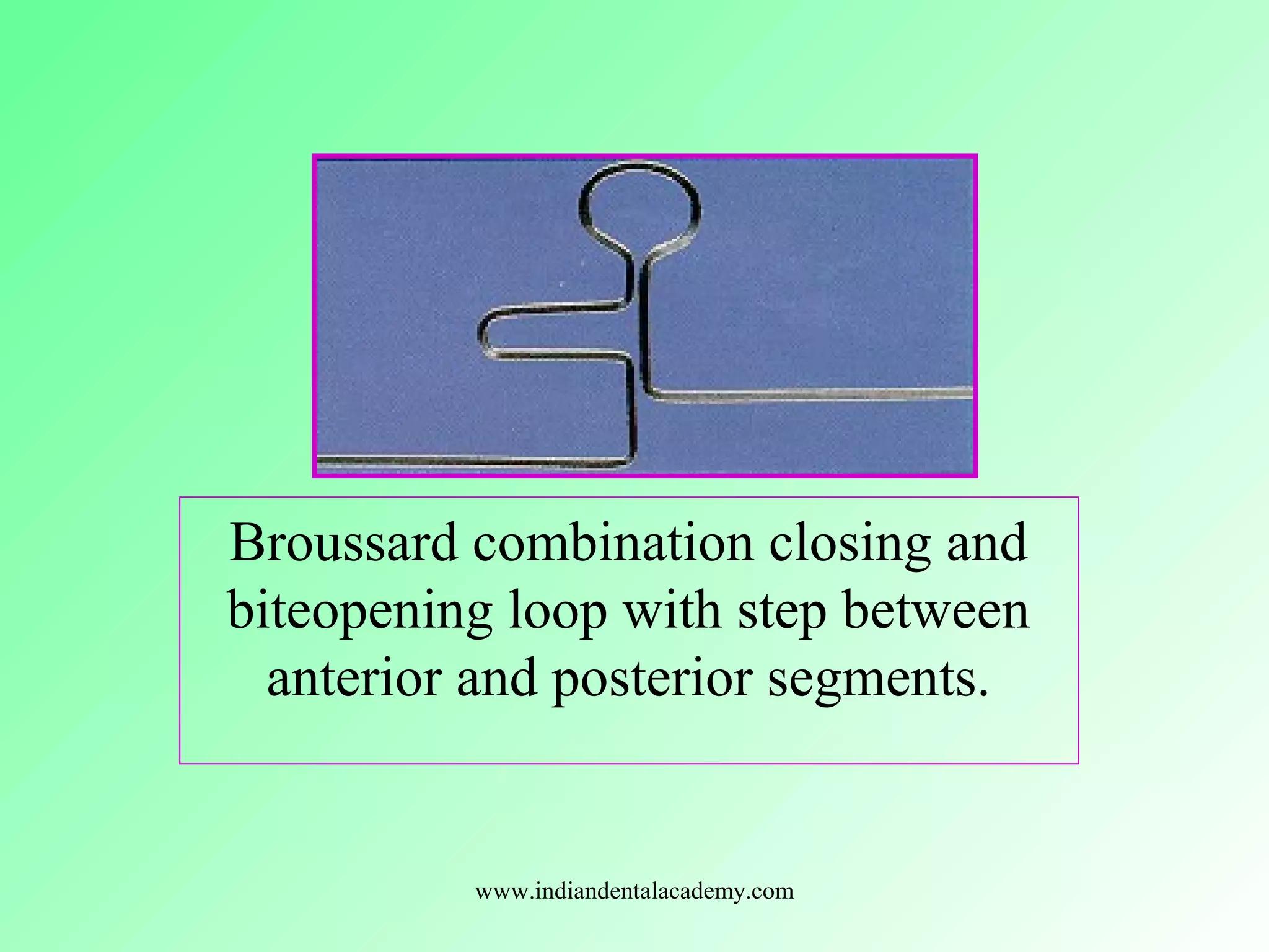 Broussard combination closing and
biteopening loop with step between
anterior and posterior segments.
www.indiandentalacademy.com
 