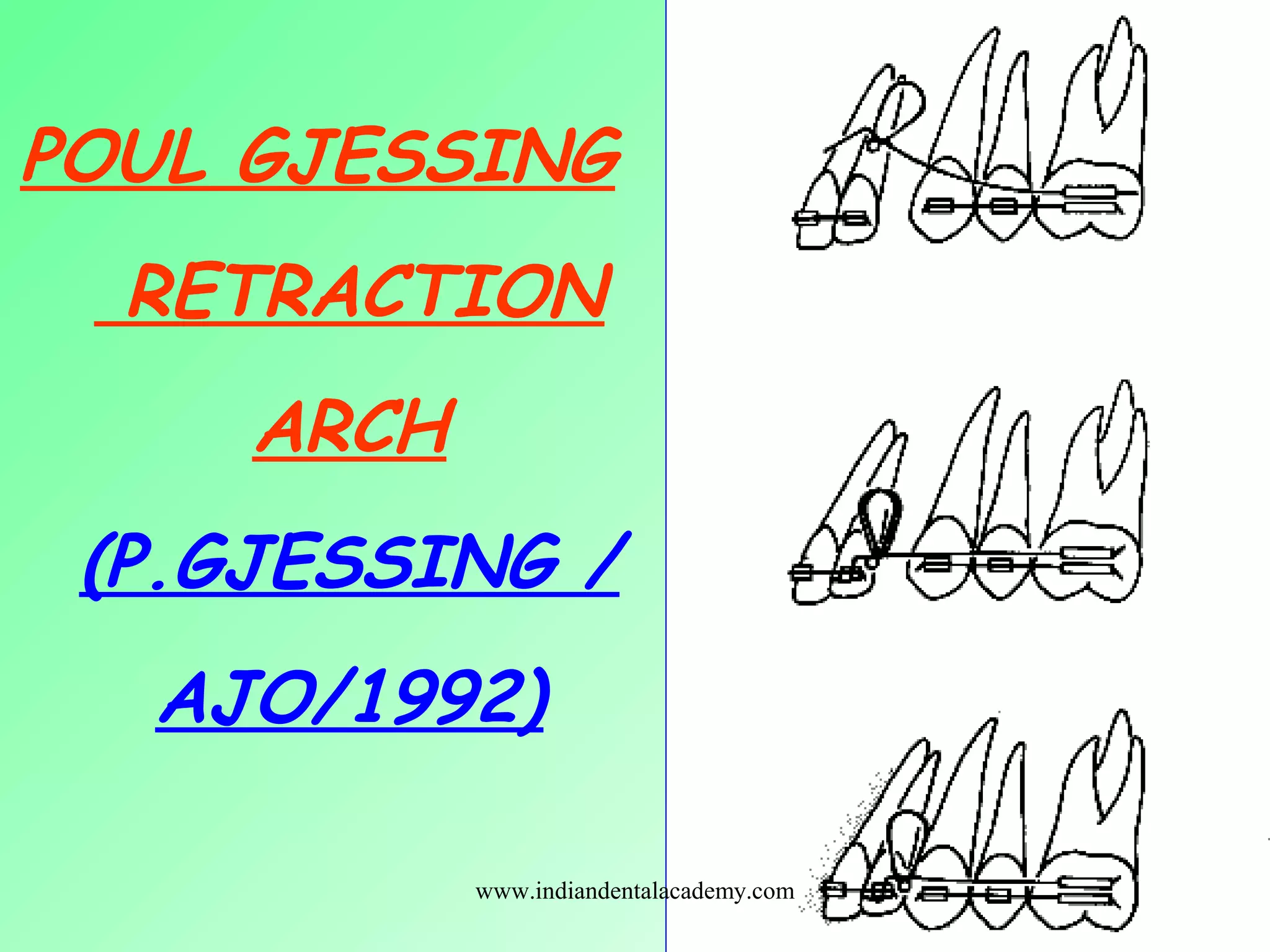 POUL GJESSING
RETRACTION
ARCH
(P.GJESSING /
AJO/1992)
www.indiandentalacademy.com
 