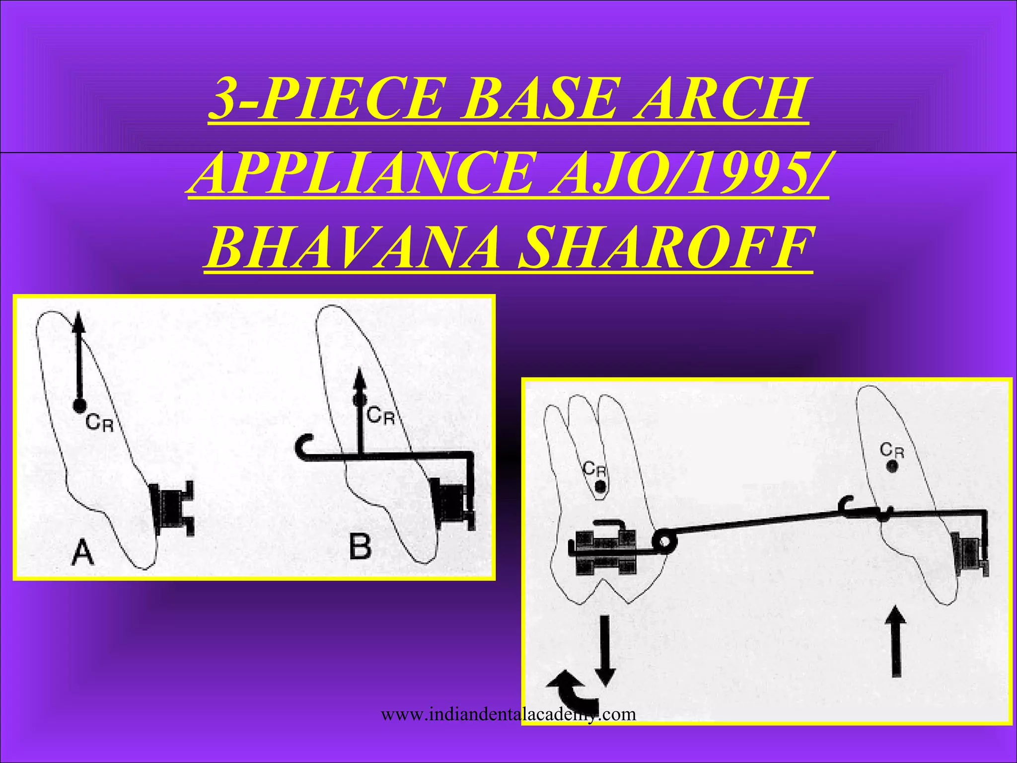 3-PIECE BASE ARCH
APPLIANCE AJO/1995/
BHAVANA SHAROFF
www.indiandentalacademy.com
 