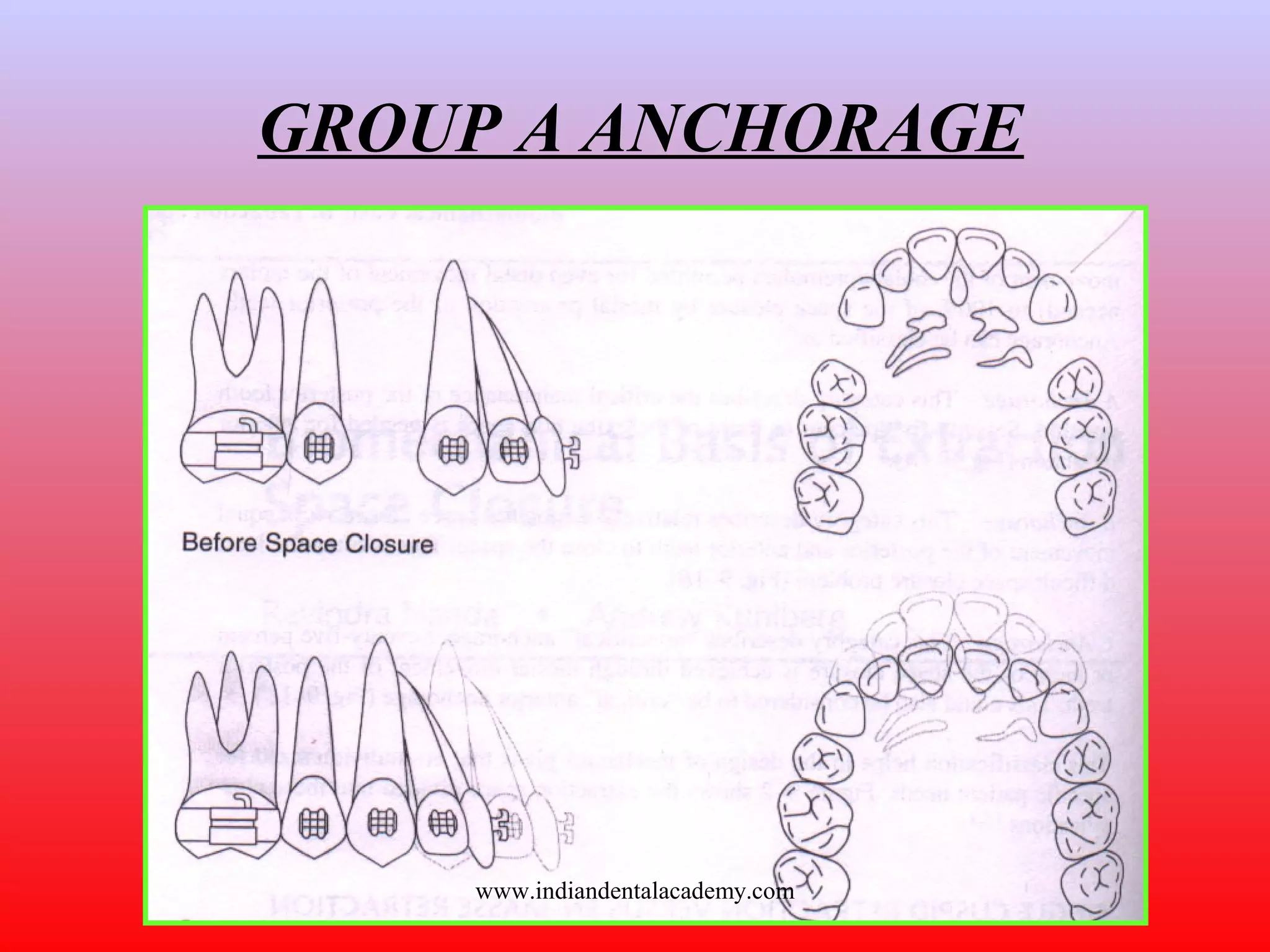 GROUP A ANCHORAGE
www.indiandentalacademy.com
 