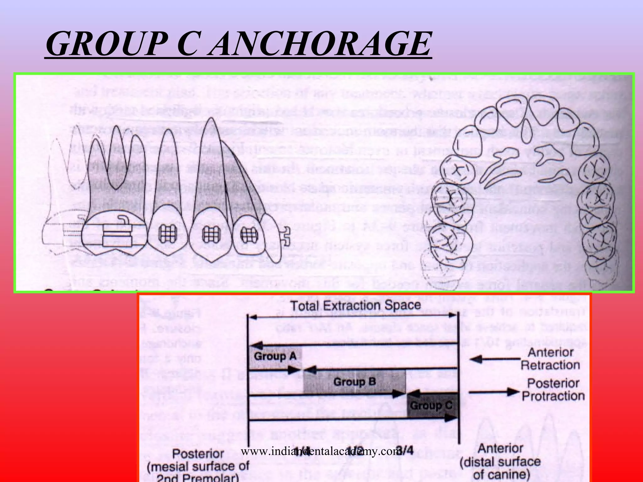 GROUP C ANCHORAGE
www.indiandentalacademy.com
 