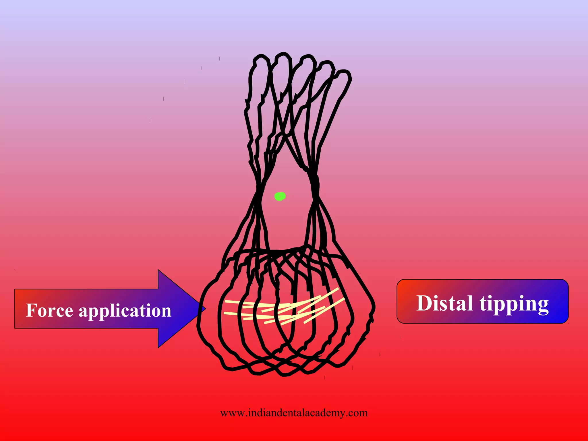 Force application Distal tipping
www.indiandentalacademy.com
 