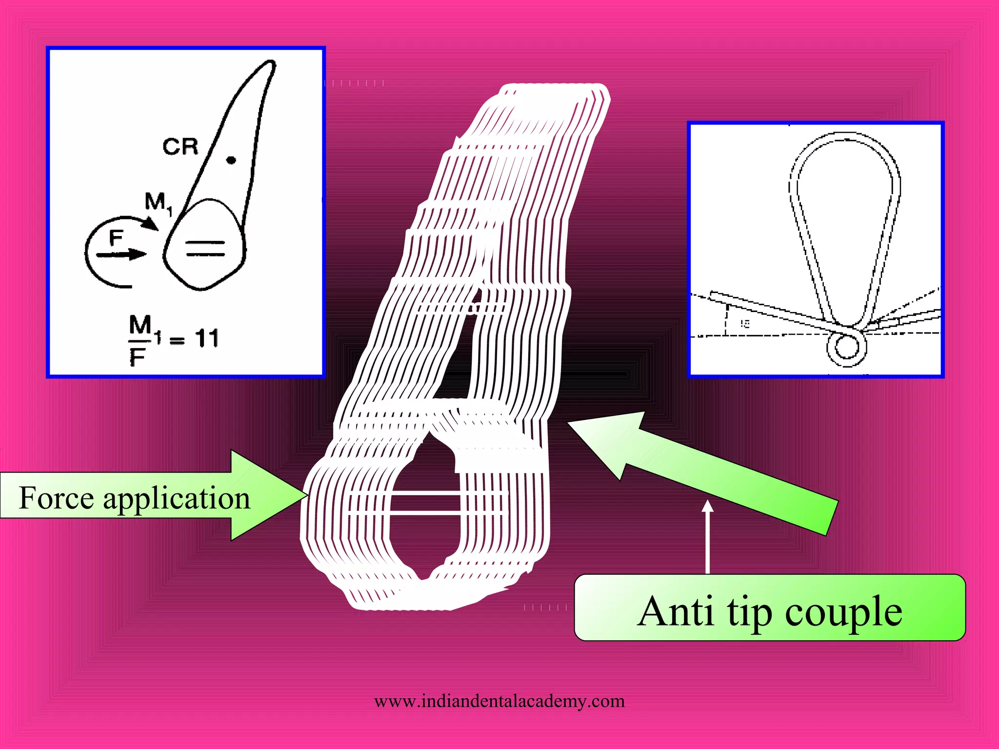 Force application
Anti tip couple
www.indiandentalacademy.com
 