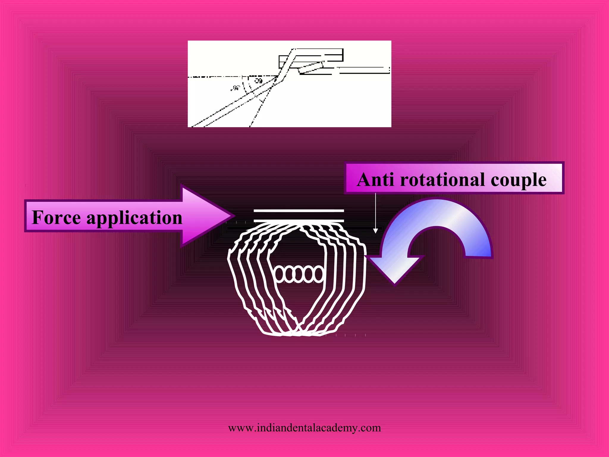 Anti rotational couple
Force application
www.indiandentalacademy.com
 
