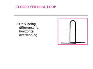 CLOSED VERTICAL LOOP
 Only being
difference is
horizontal
overlapping
 