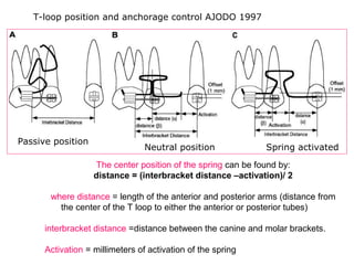 The center position of the spring can be found by:
distance = (interbracket distance –activation)/ 2
where distance = length of the anterior and posterior arms (distance from
the center of the T loop to either the anterior or posterior tubes)
interbracket distance =distance between the canine and molar brackets.
Activation = millimeters of activation of the spring
Passive position
Neutral position Spring activated
T-loop position and anchorage control AJODO 1997
 