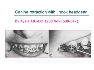 Canine retraction with j hook headgear
By Ayala AJO-DO 1980 Nov (538-547):
 