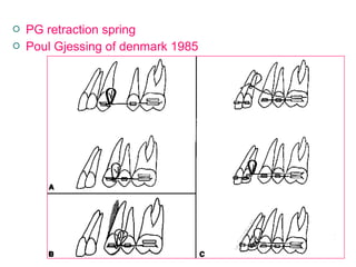  PG retraction spring
 Poul Gjessing of denmark 1985
 