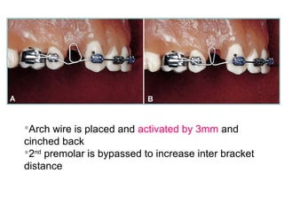 Arch wire is placed and activated by 3mm and
cinched back
2nd
premolar is bypassed to increase inter bracket
distance
 