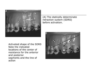 (A) The statically determinate
retraction system (SDRS)
before activation.
Activated shape of the SDRS
Note the indicated
locations of the center of
resistance for the anterior
and posterior
segments and the line of
action
 